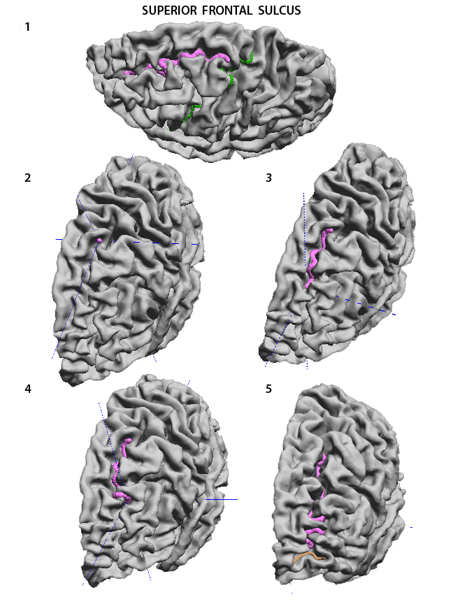 Supraorbital Sulcus