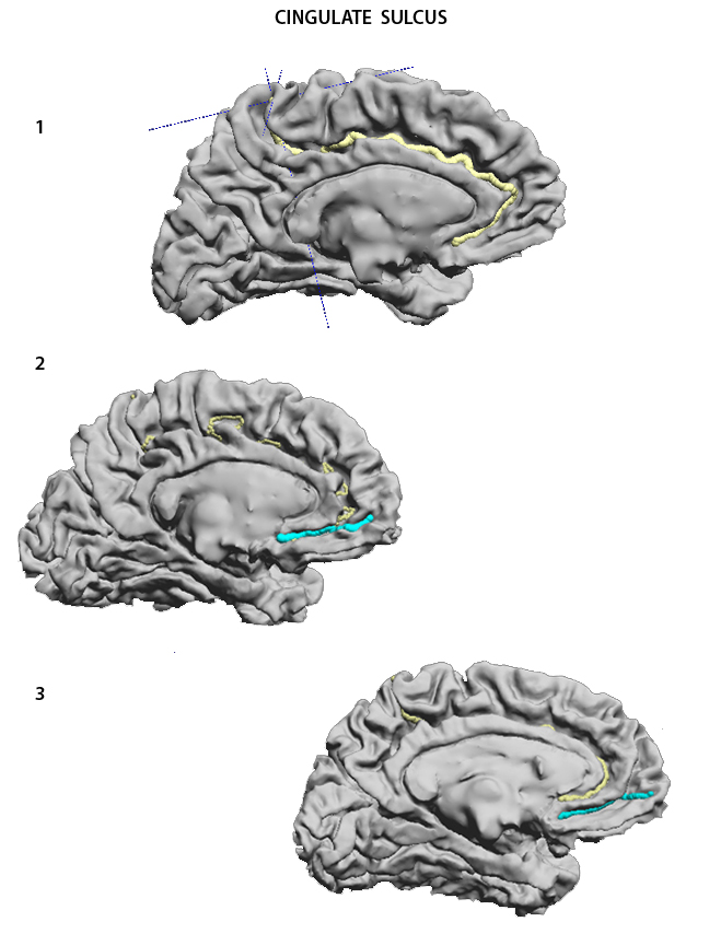 Cingulate Sulcus