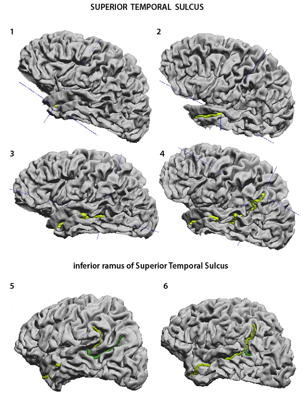 middle temporal sulcus