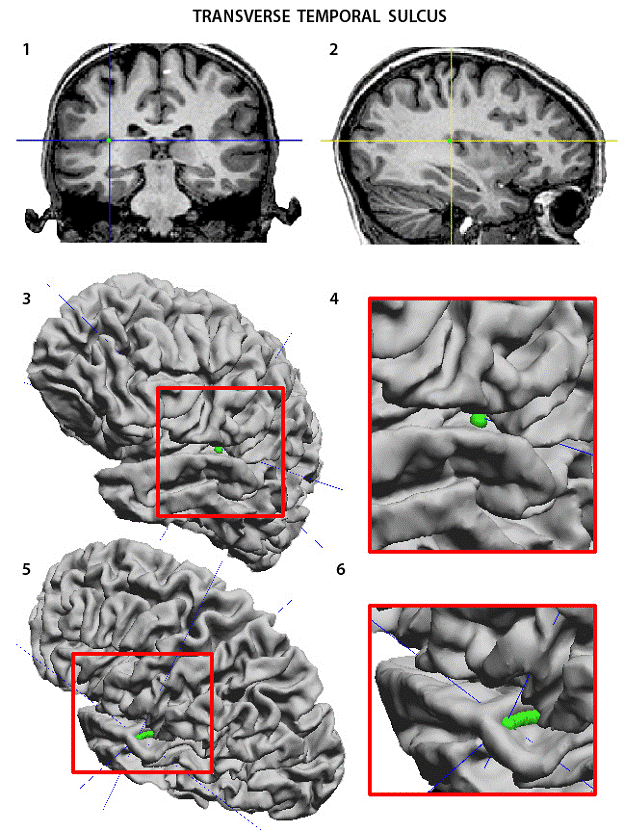 superior temporal sulcus