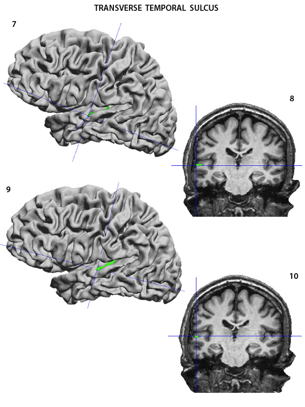 transverse temporal sulcus