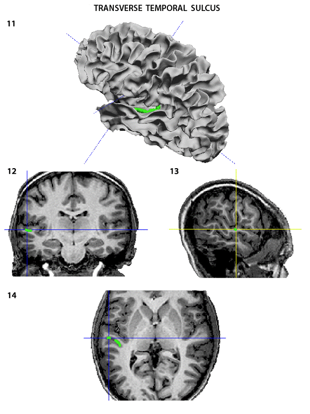 transverse temporal sulcus