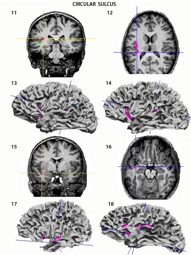 Circular Sulcus