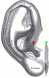 preauricular.gif