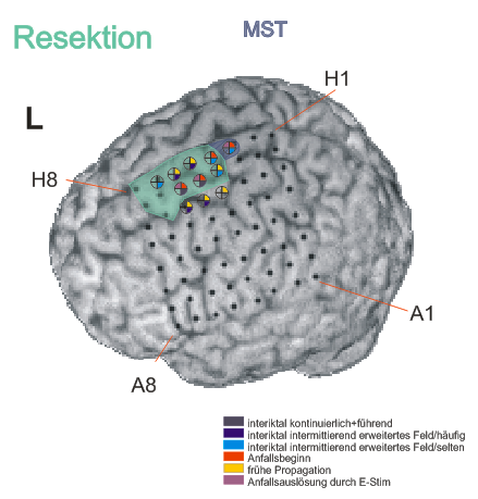 sub-ecog01_ses-postimp_acq-render01_photo.png