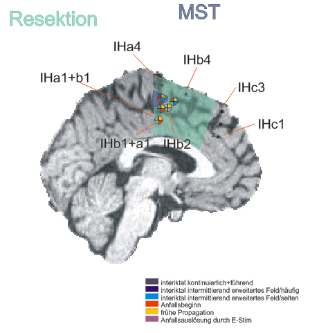 sub-ecog01_ses-postimp_acq-render02_photo.png