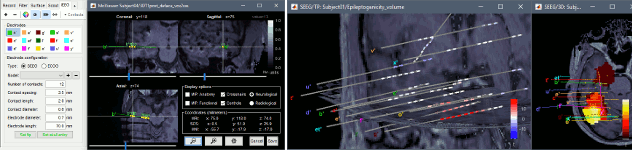 epileptogenicity.gif