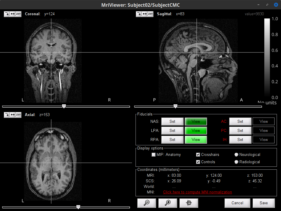 https://neuroimage.usc.edu/brainstorm/Tutorials/CorticomuscularCoherence?action=AttachFile&do=get&target=mri_viewer.png