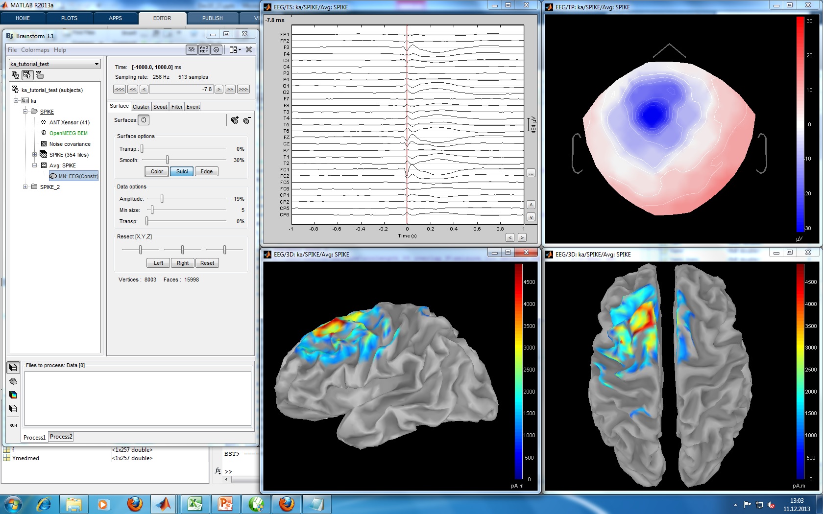 SL_MNE_tutorial_patient.jpg