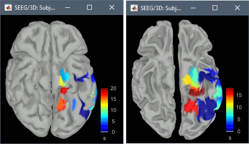 anat_brainvisa_delay.gif