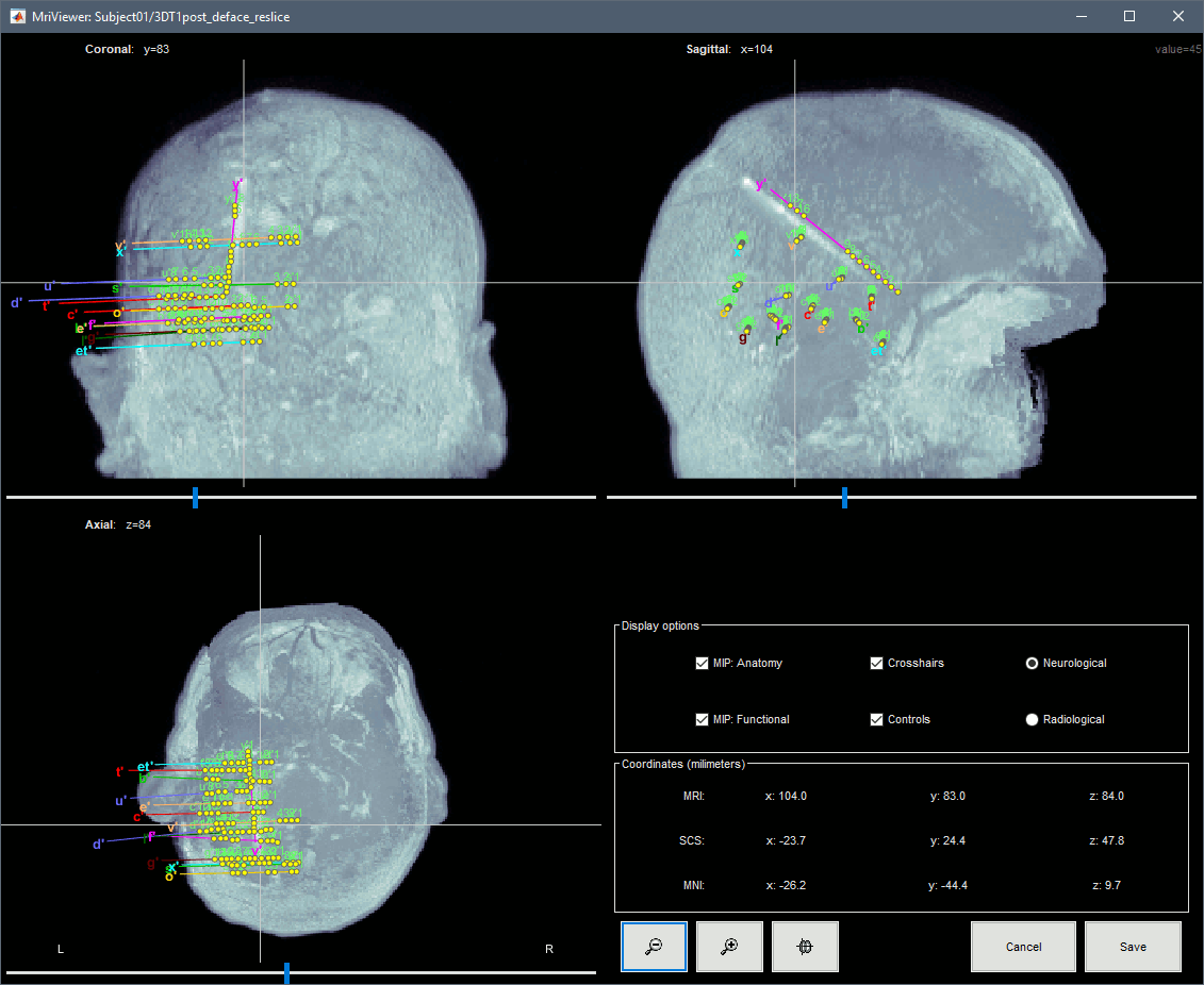 display_mri_mip.gif