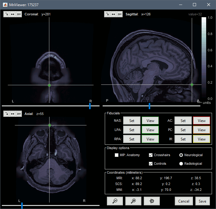 anat_mri.gif