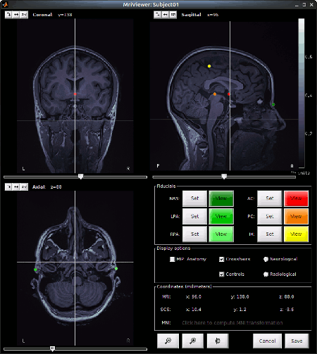 NIRSTORM_tut_nirs_tapping_MRI_edit.gif