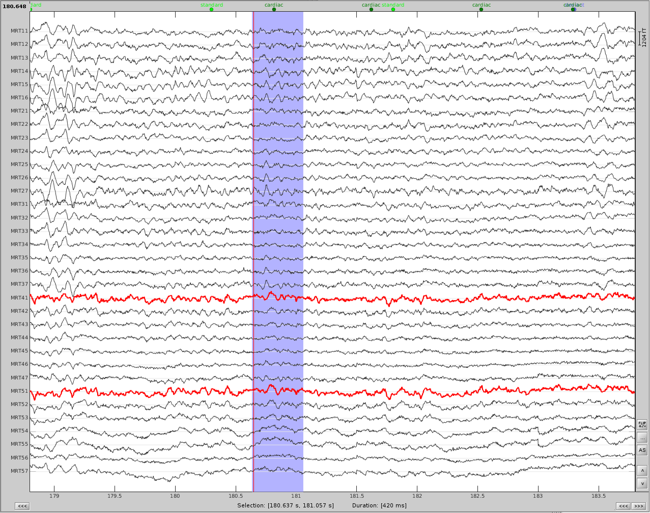 cardiac_artifact_after.png