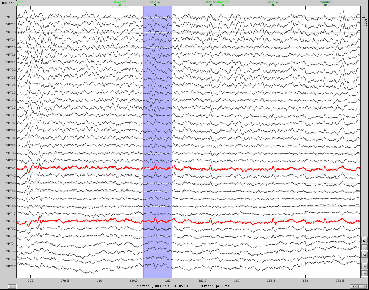 cardiac_artifact_before.png