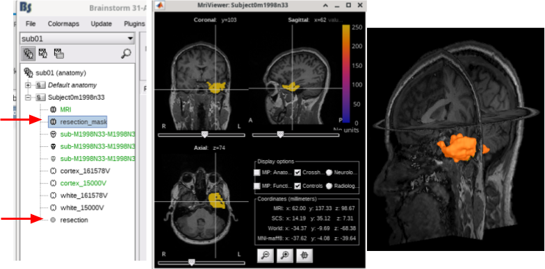 resection_labeling3.png