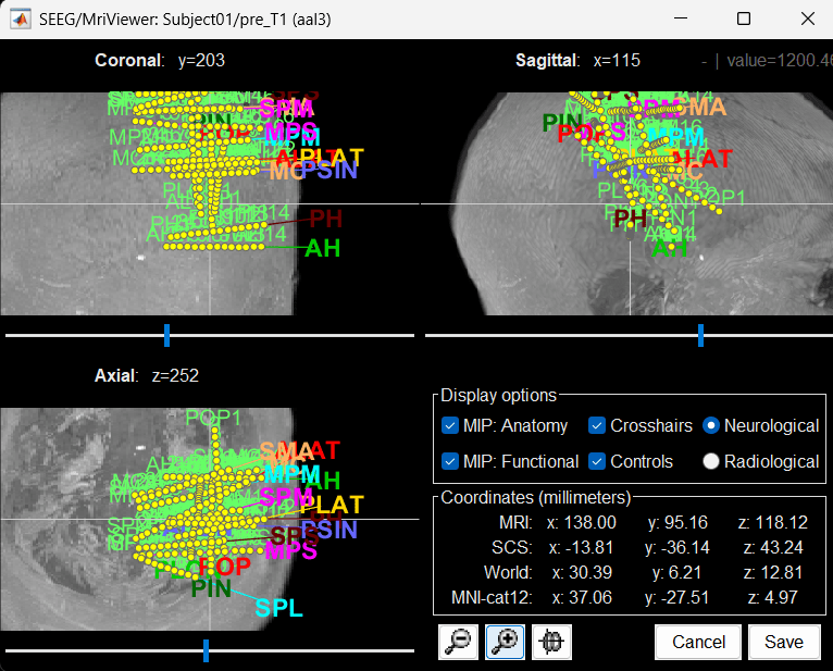 27_display_mri_mip.png