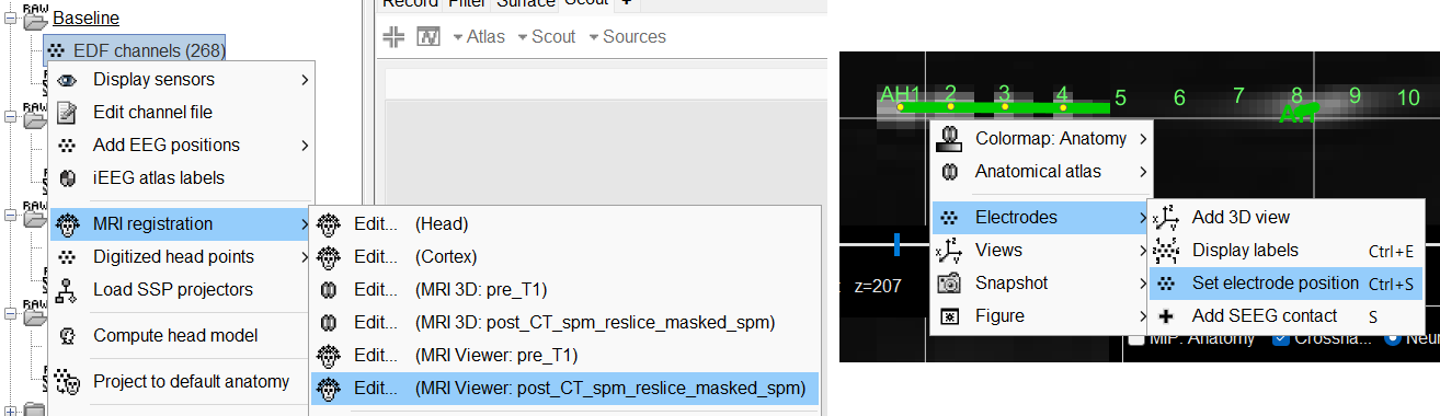 28_mri_edit_contacts_postions.png