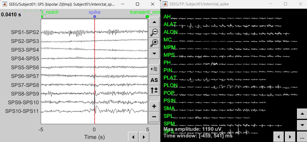 63_disp_ts_interictal.png