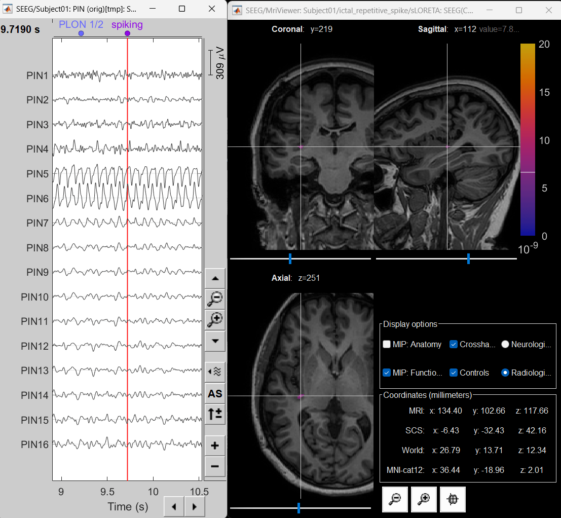 81_inverse_model_res_ictal.png