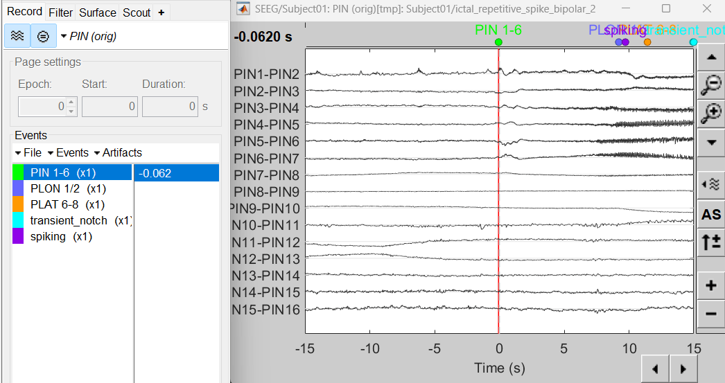 77_time_series_ictal.png