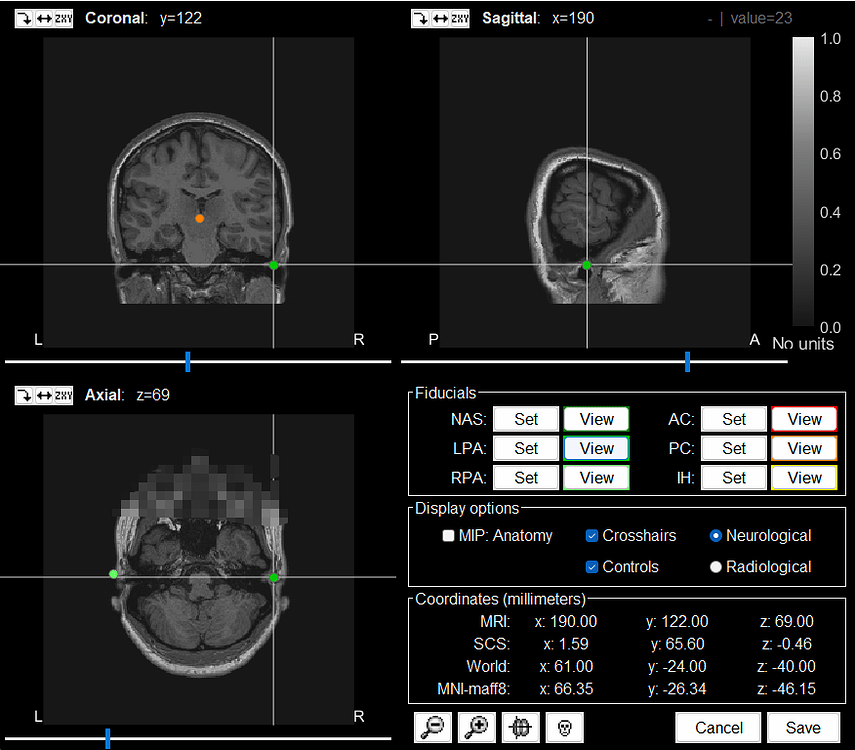 Incorrect coordinate axis direction in MRI registration - Discussions ...
