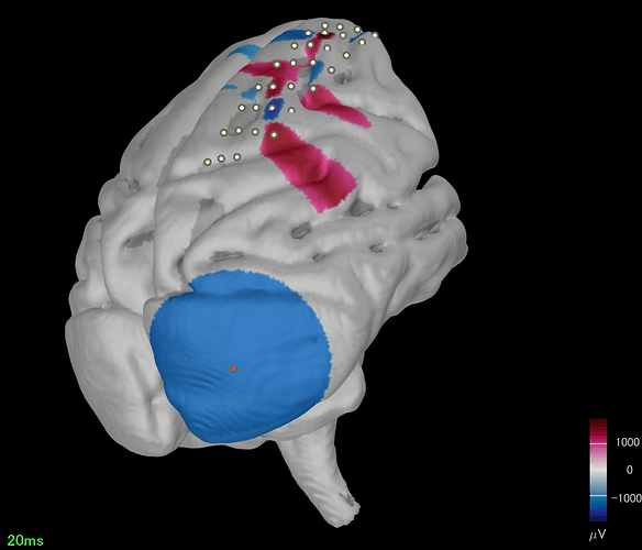 皮質下活動の広がりが大きすぎ-ECOG_3D_test04_EEGtest