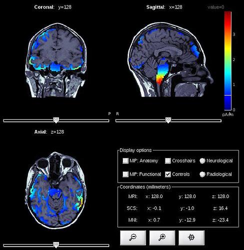 EEG_MriViewer_DB10_11