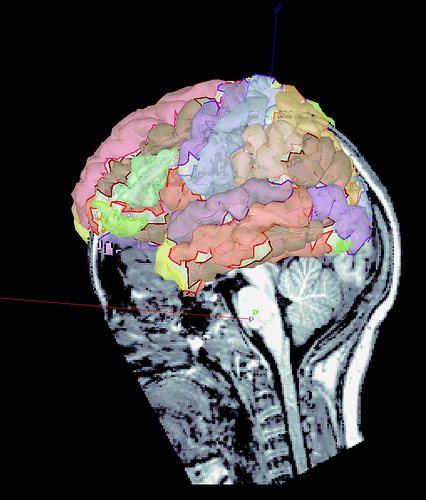 brainsuite misalignment 2