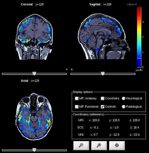 EEG_MriViewer_DB10_11_MN_MEG_ALL_Mixed_2018