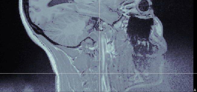 MriInfNoise