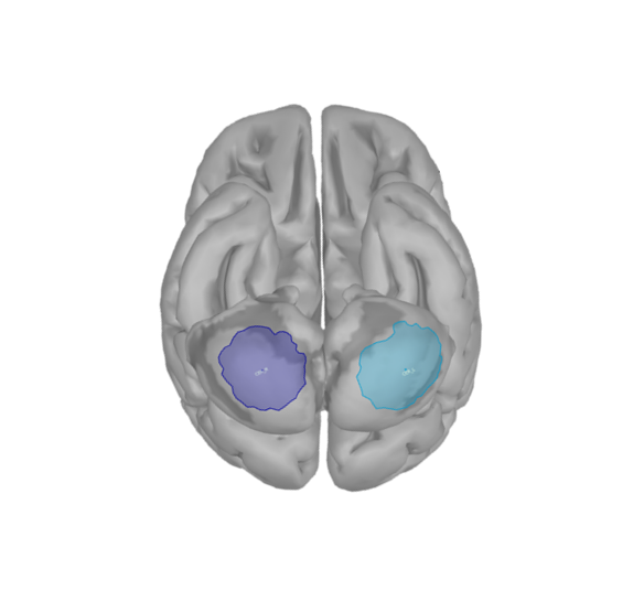 bilateral cerebellum